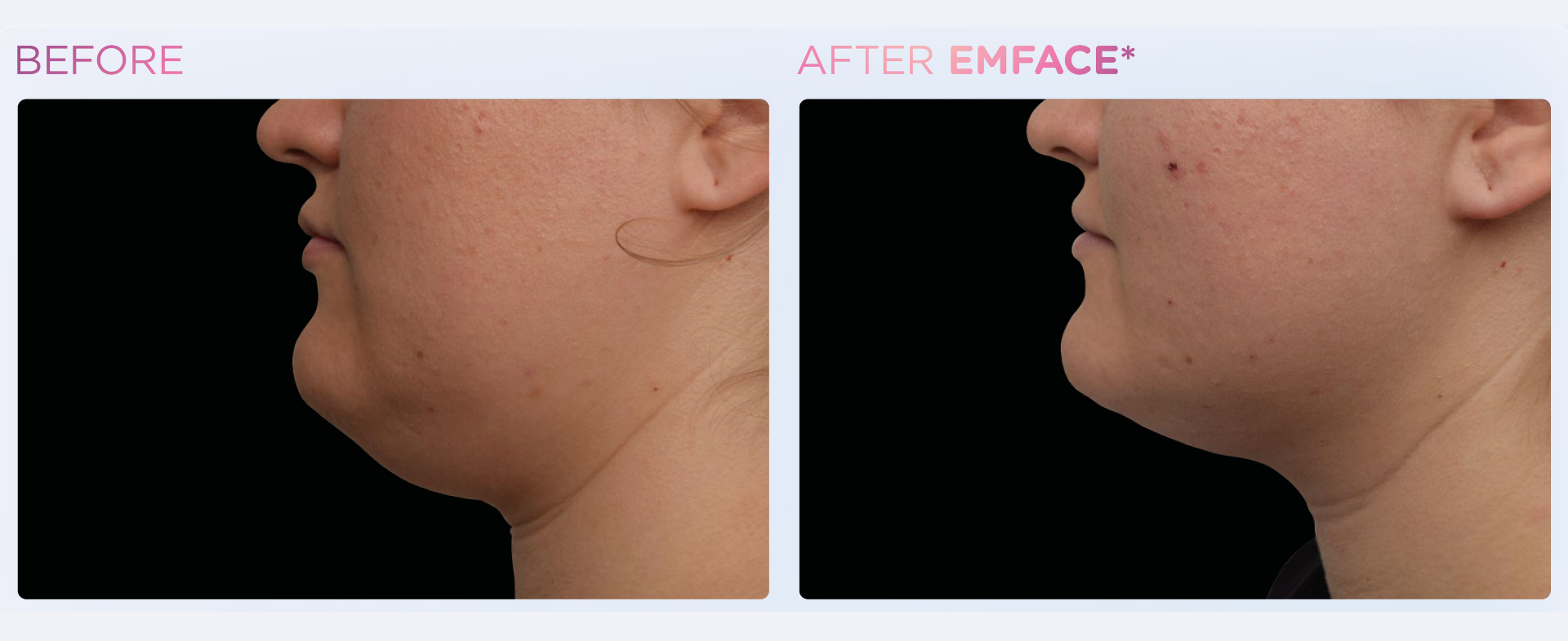 Lift & Tone Your Face Today with EMFACE!