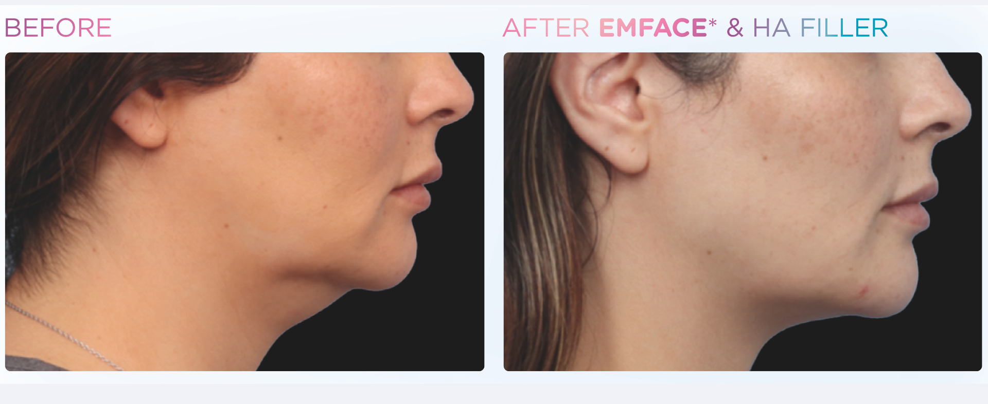 Transform Your Look with EMFACE® Submentum Today!