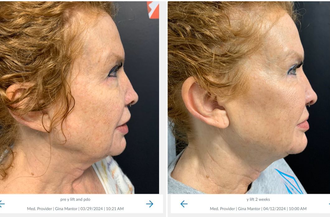 Double-Board certified Dr. Gina Mantor offers PDO Thread Lifts in Westerville, OH. Free consultations.