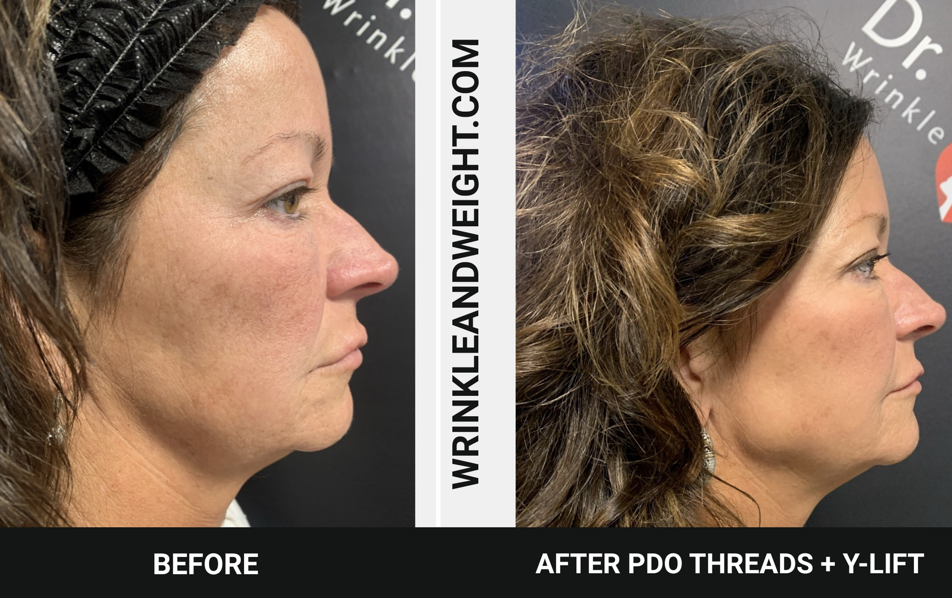 Pdo threads and the Y-lift results performed by Dr. Gina Mantor at her Westerville Medical spa