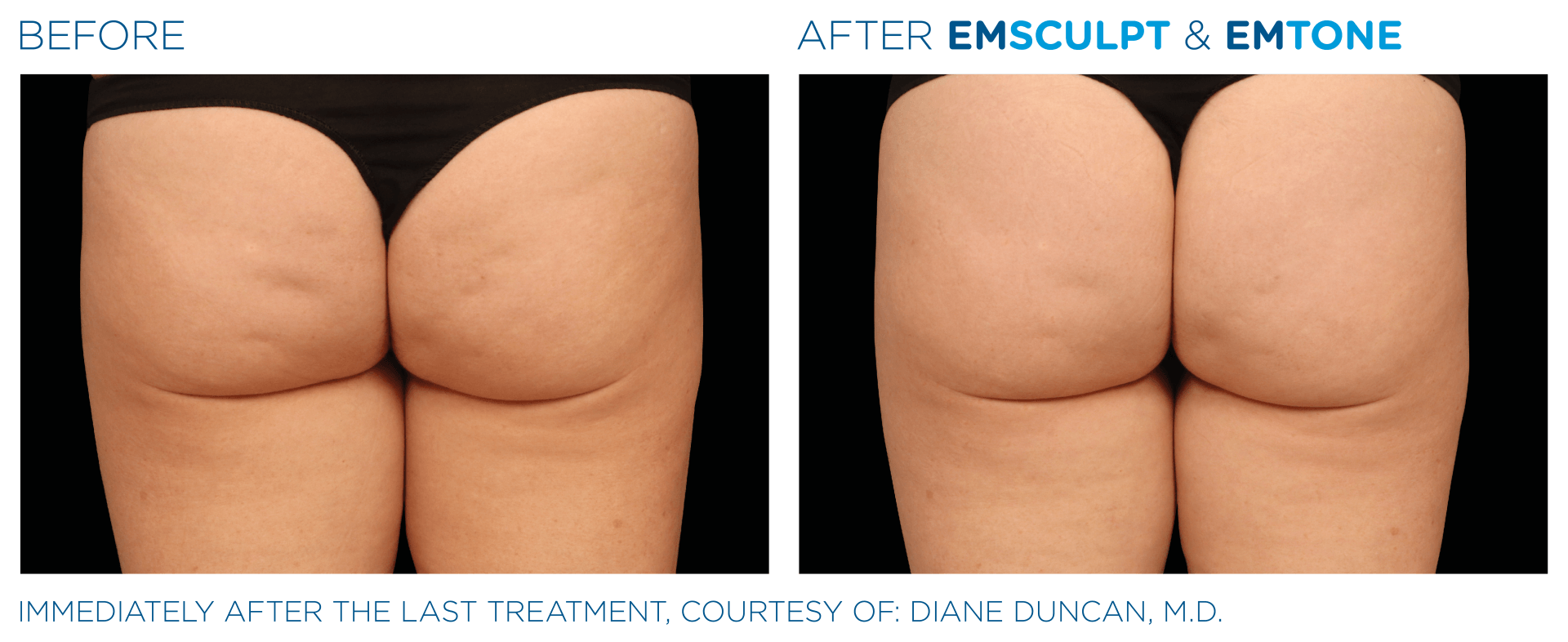 EmSculpt Neo: Because who needs crunches when you can zap your fat away? Try it for free!