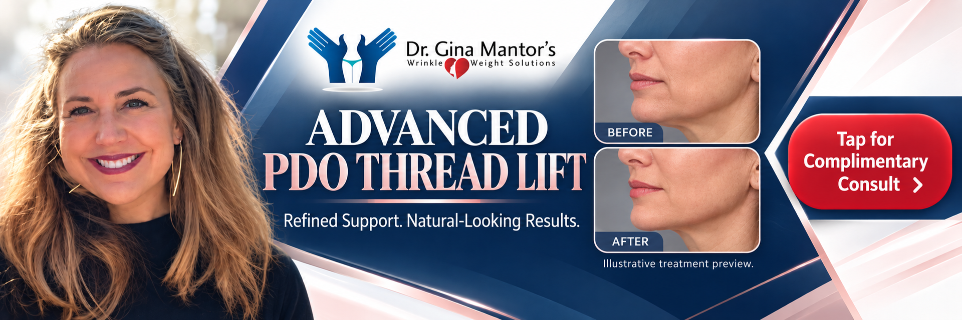 advanced pdo thread lifts now at Dr. Mantor's Wrinkle and Weight Solutions in Westerville, Ohio