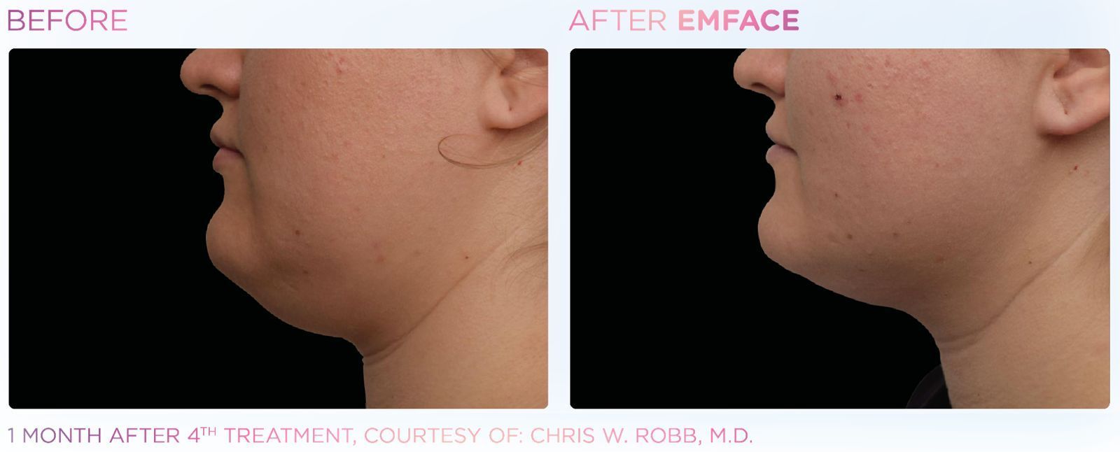 Achieve a youthful look with EMFACE™, the needle-free solution for lifting and firming your double chin.