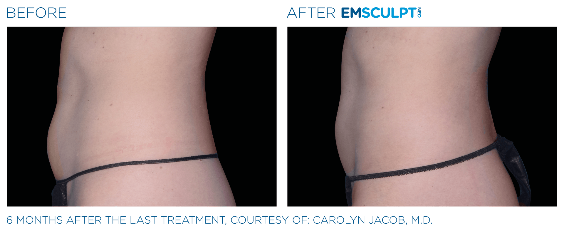 Experience the power of Emsculpt, with each session delivering the results of 20,000 crunches.