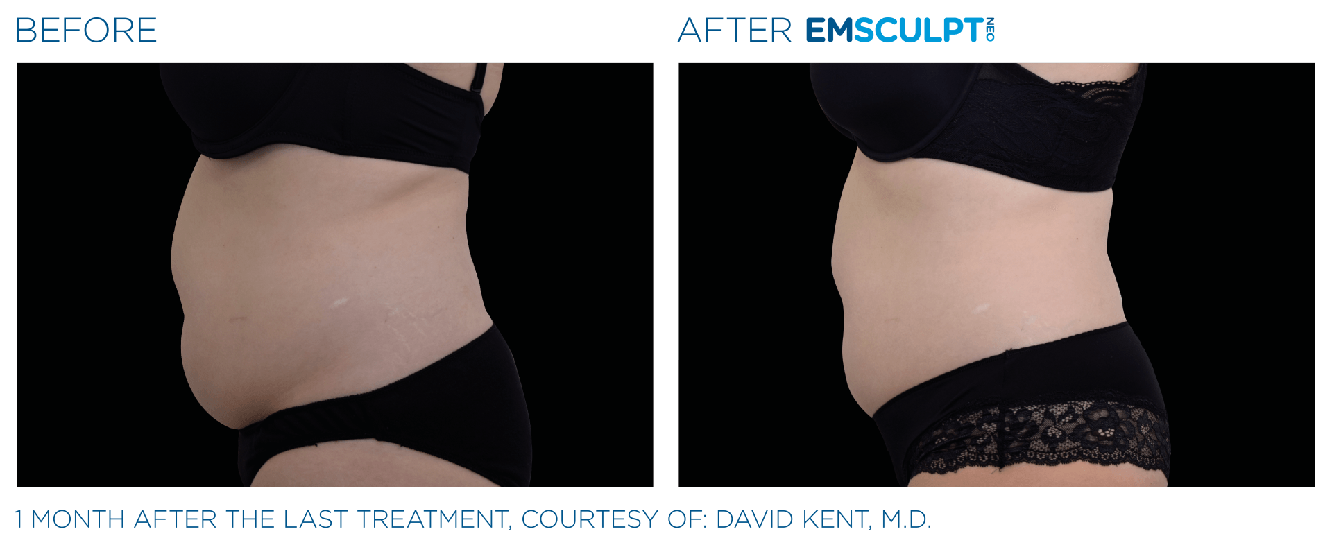 Experience real results with FDA-cleared Emsculpt body sculpting. Non-invasive and proven. Free trial available.