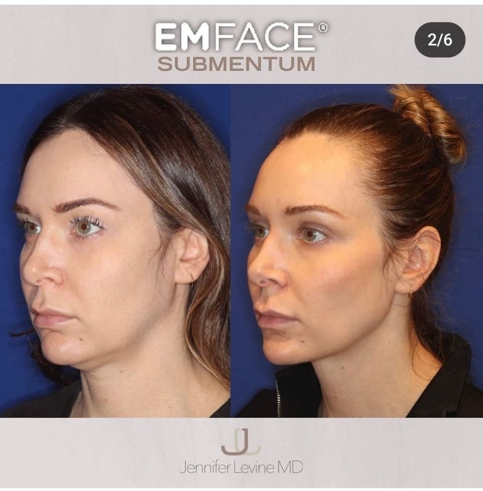 EMFACE™ offers a needle-free, toxin-free facial lift and skin remodeling with no downtime, enhancing volume and tone.