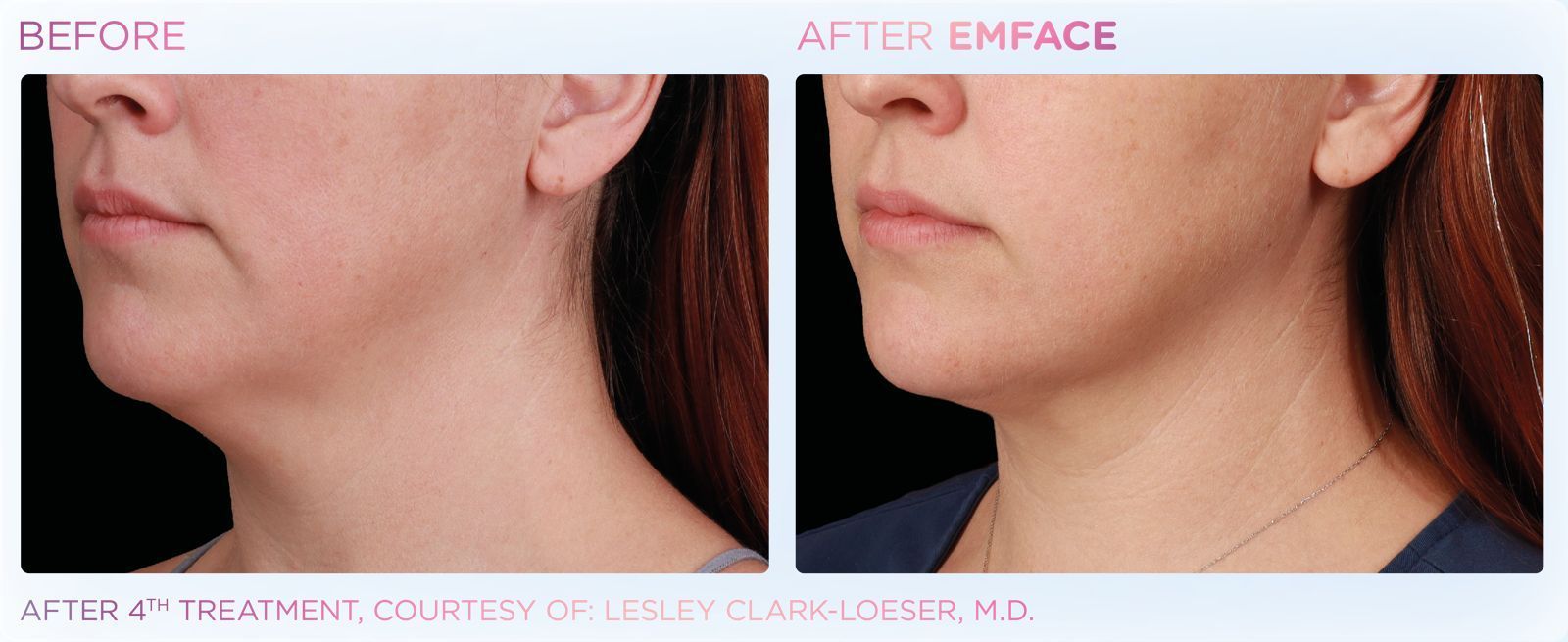 EMFACE™ offers a sophisticated, needle-free face lift, enhancing jawline and skin tone without toxins or downtime.
