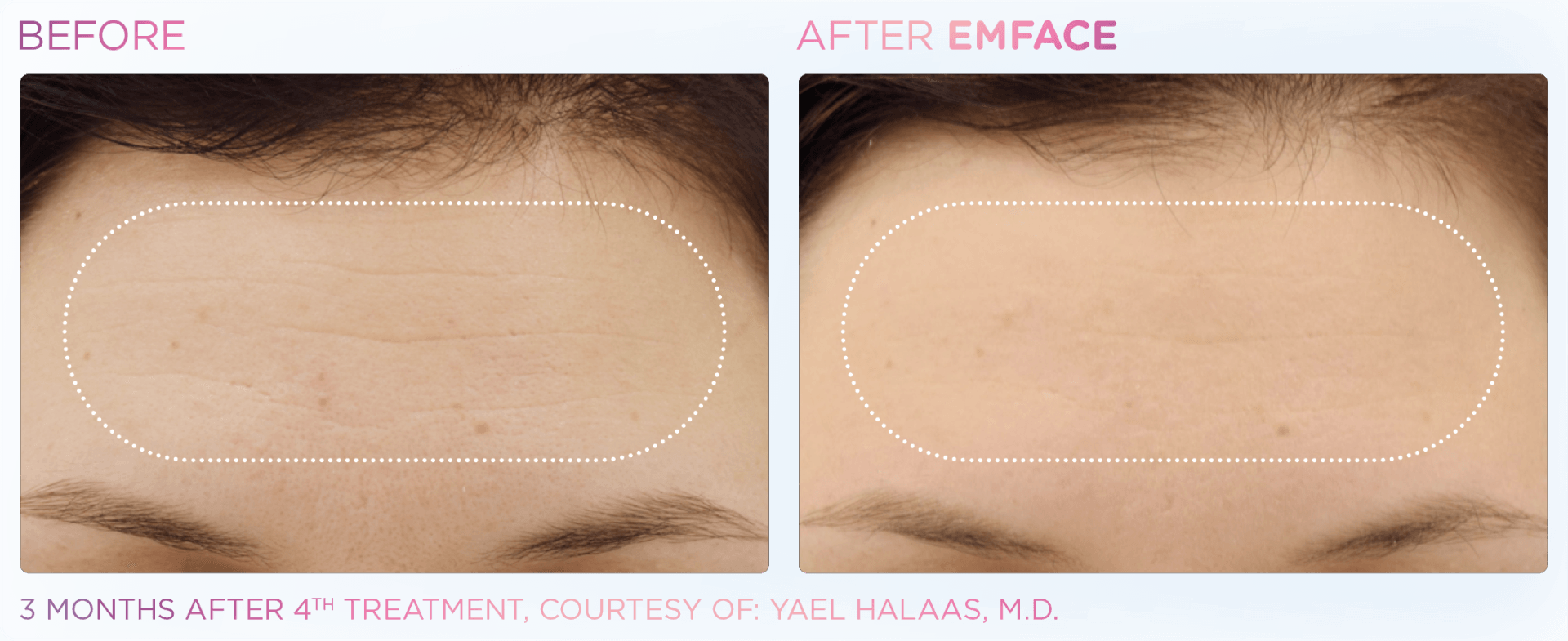 Emface offers a needleless, non-surgical solution to tone, lift, and rejuvenate your face with no downtime.