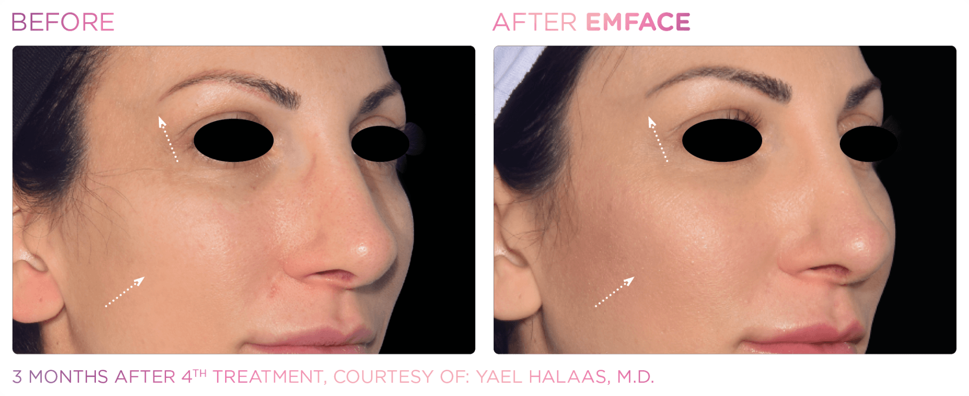 Discover Emface: A groundbreaking needleless facial contouring treatment for a youthful, radiant complexion without downtime.
