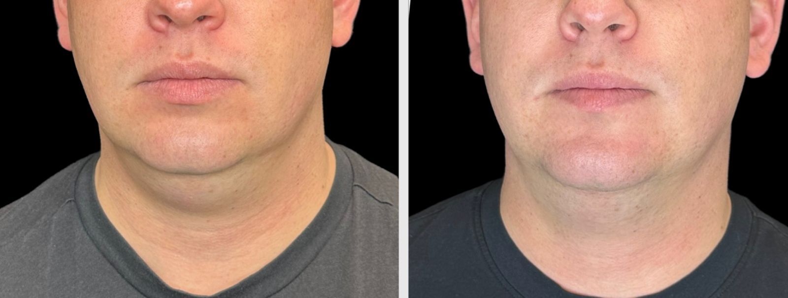 Experience innovative skin rejuvenation with EMFACE™—a toxin-free, non-invasive face lift that tightens and volumizes.