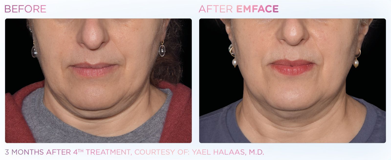 Rejuvenate your face using EMFACE™ dual technology, combining advanced wrinkle reduction with enhanced muscle care.