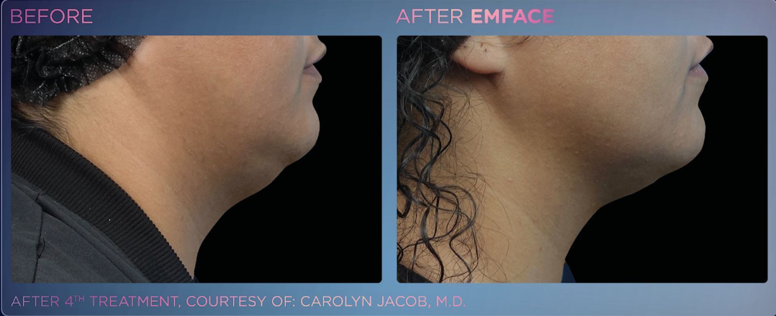 Elevate your skincare routine with EMFACE™, delivering a toxin-free face lift and improved jawline with zero downtime.