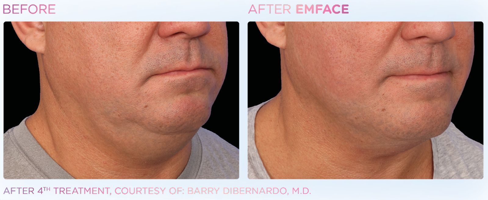 EMFACE™ offers a non-invasive double chin lift, enhancing skin tone and volume without needles or toxins.