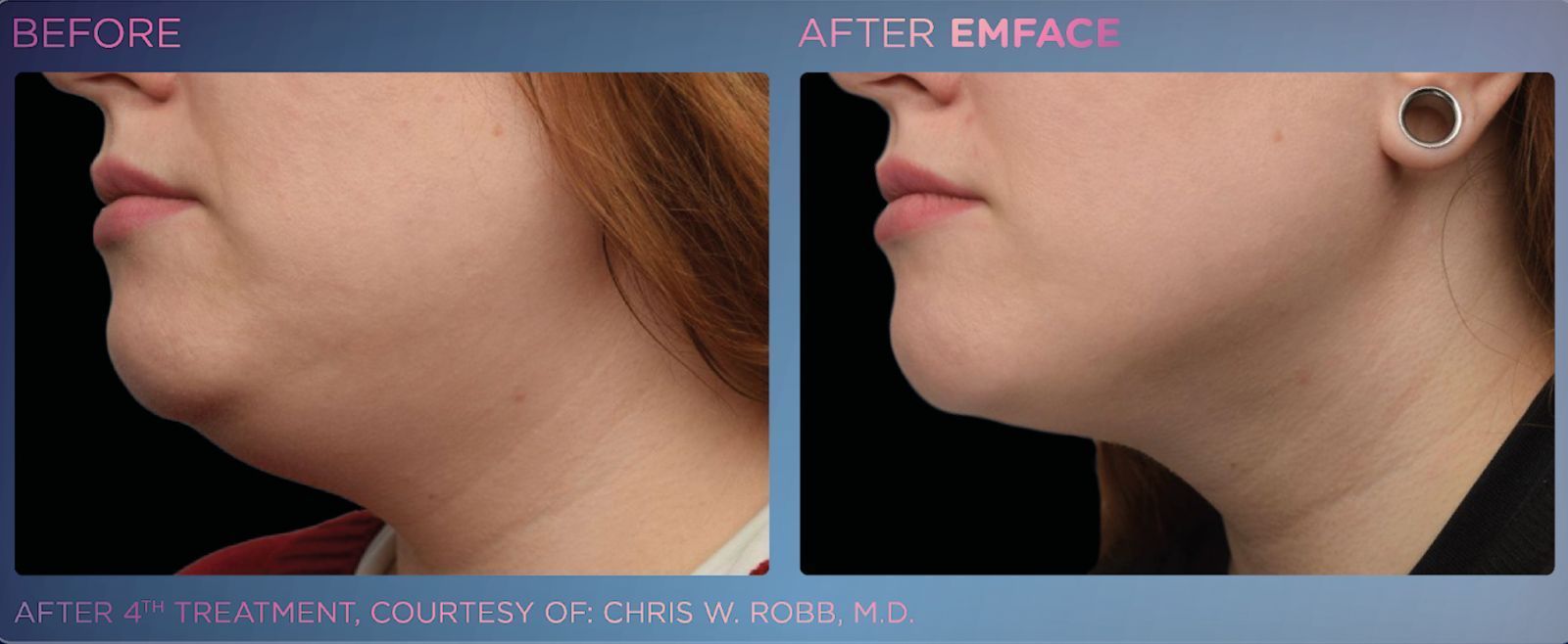 EMFACE™ provides a safe, effective double chin lift, improving skin tone and volume with zero downtime.