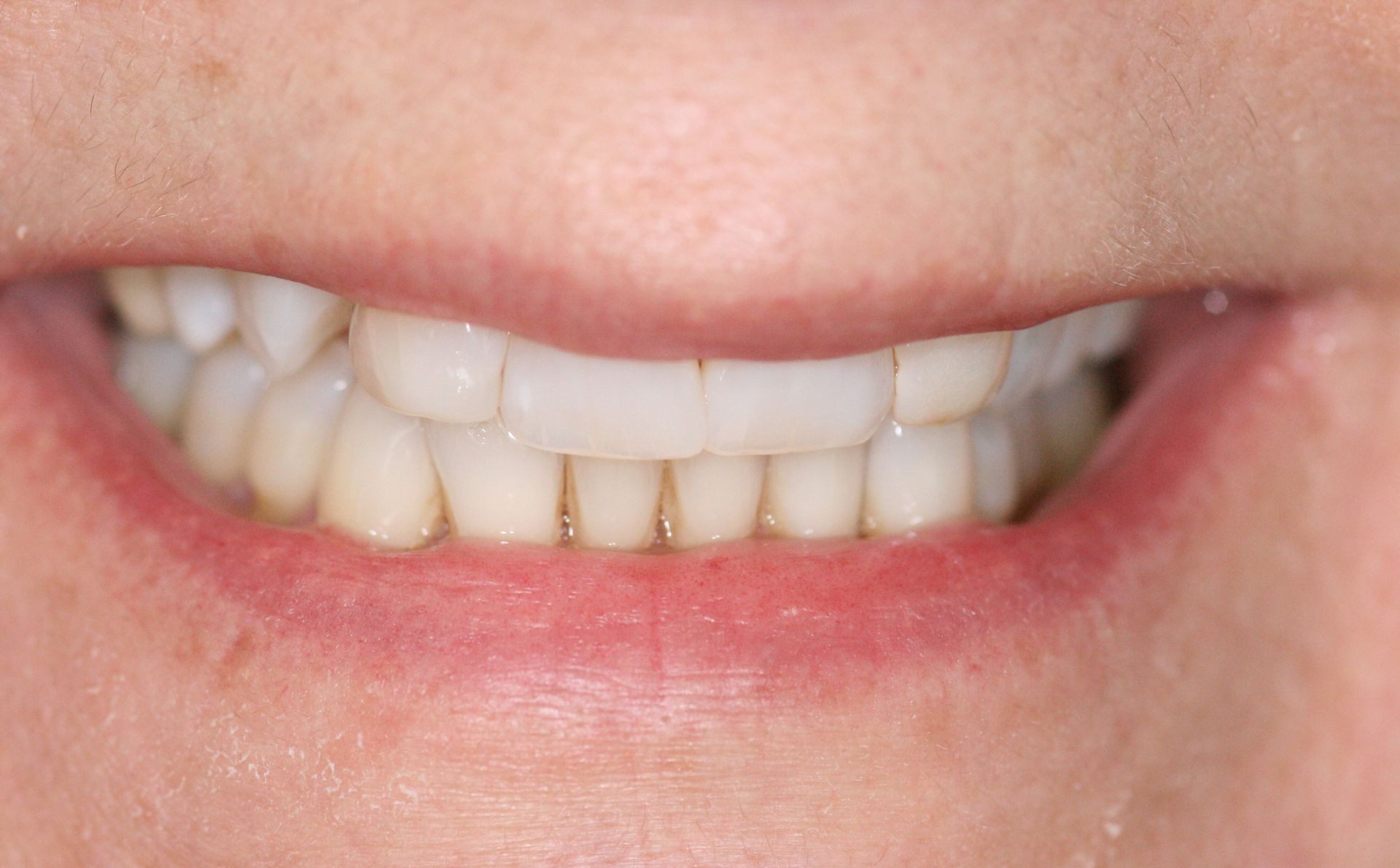 Close-up of a smiling mouth showing white teeth with slight yellowing at the gums