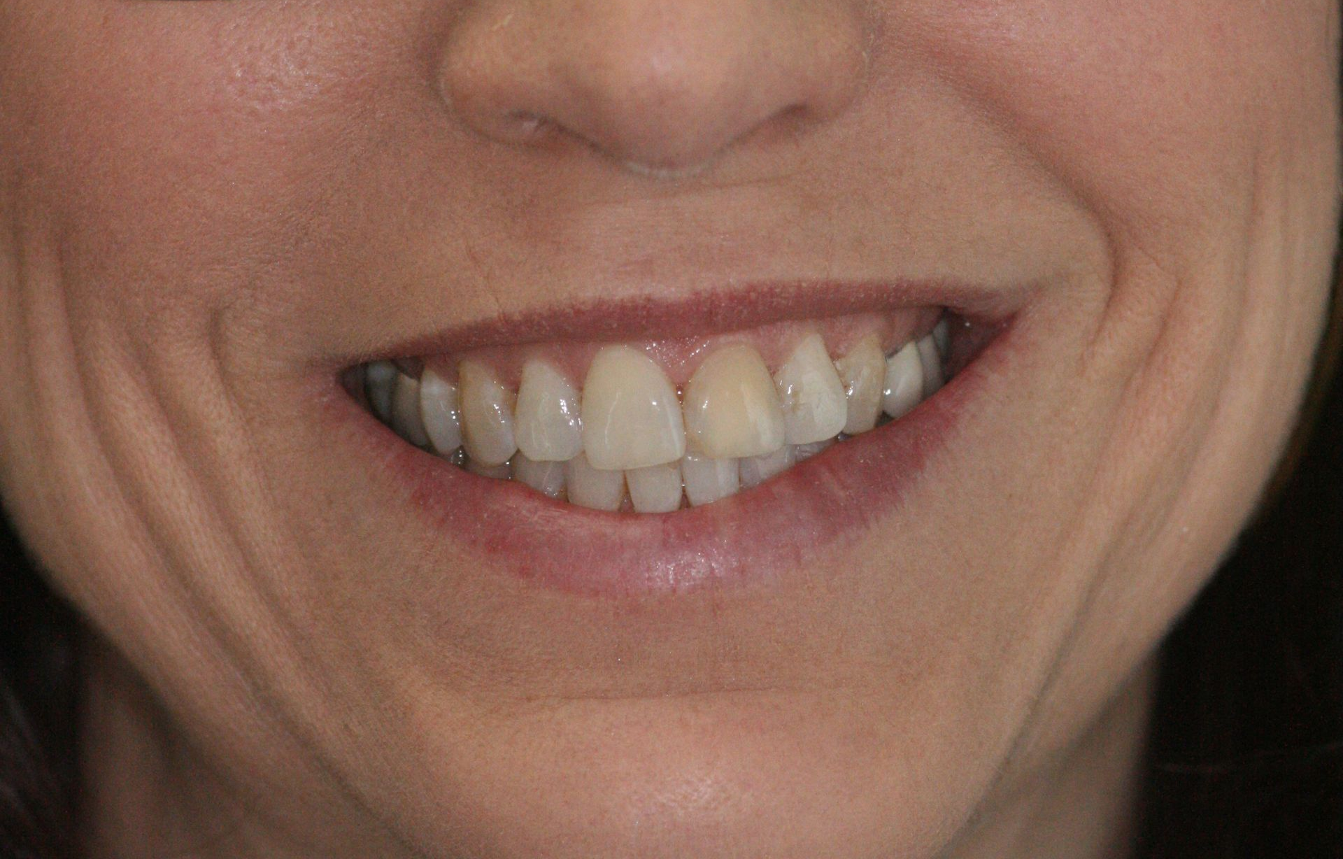 Close-up of a smiling mouth showing teeth, with glossy pink lips