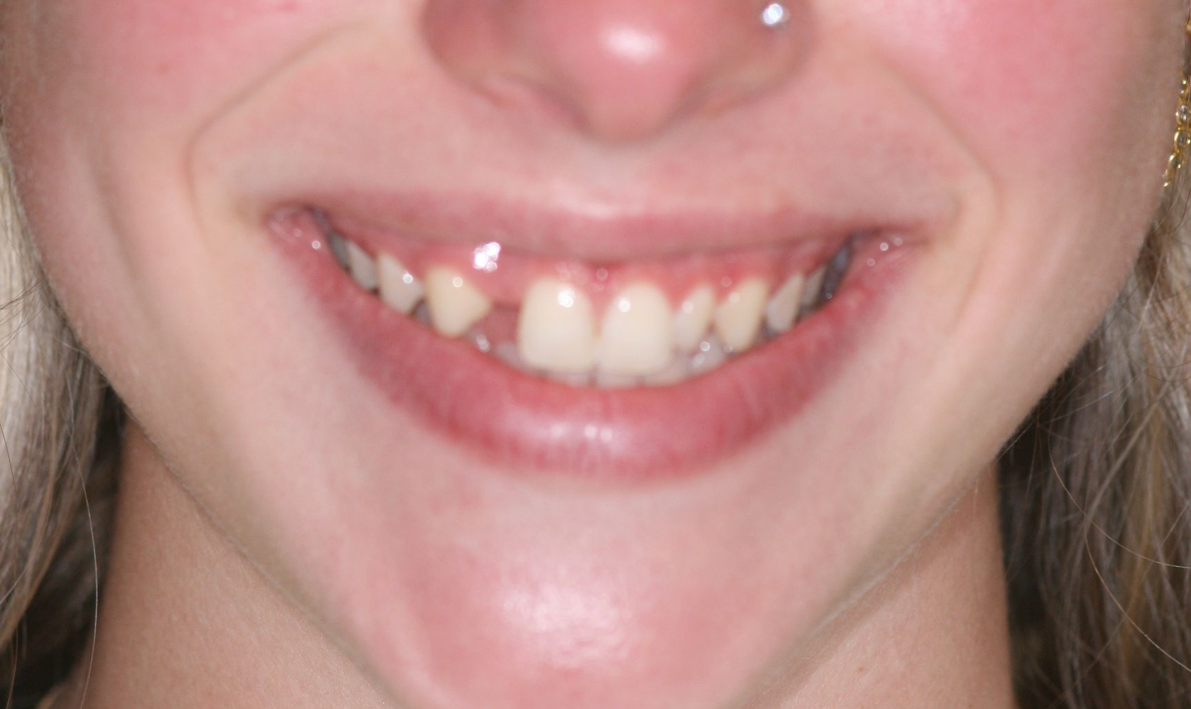 Close-up of a smiling mouth with a nose piercing and a small gap between the front teeth