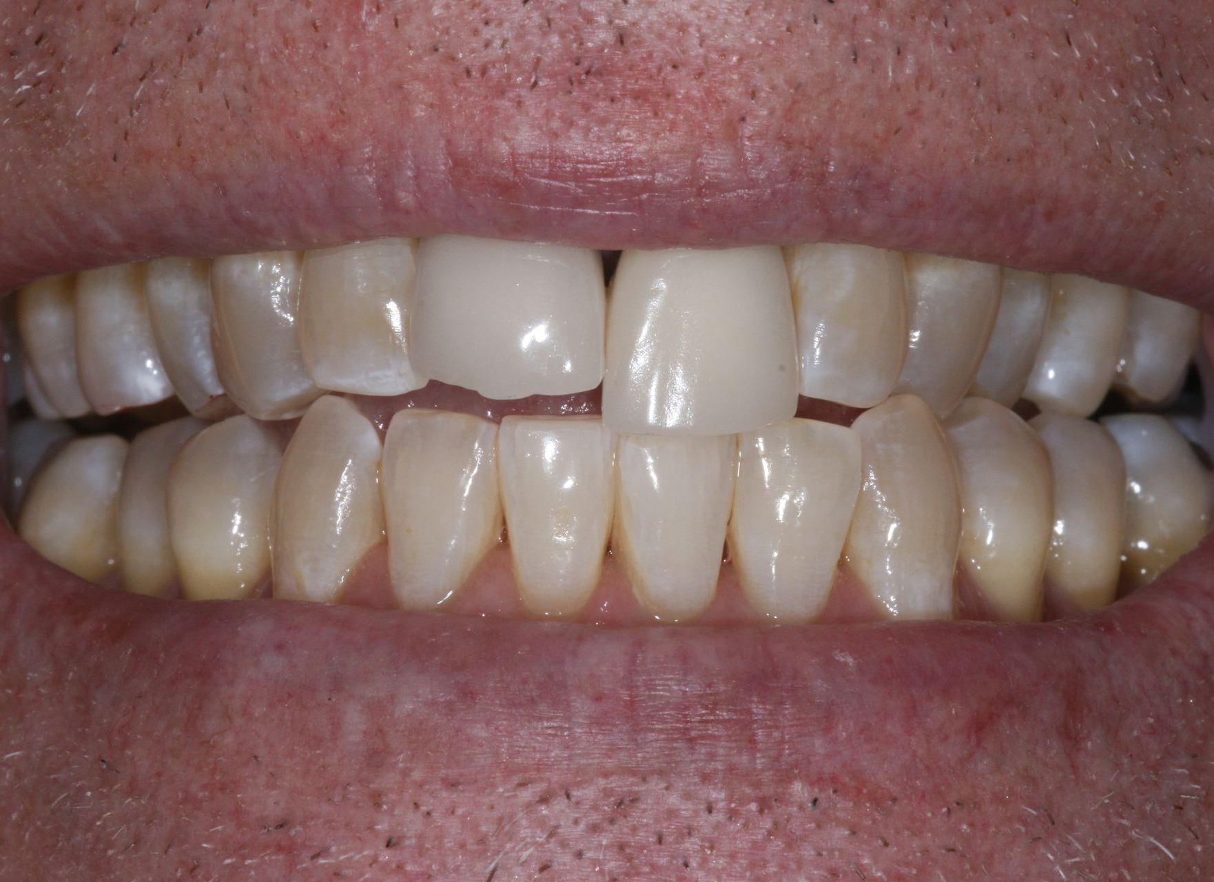 Close-up of teeth with visibly stained upper front teeth and crowded lower teeth