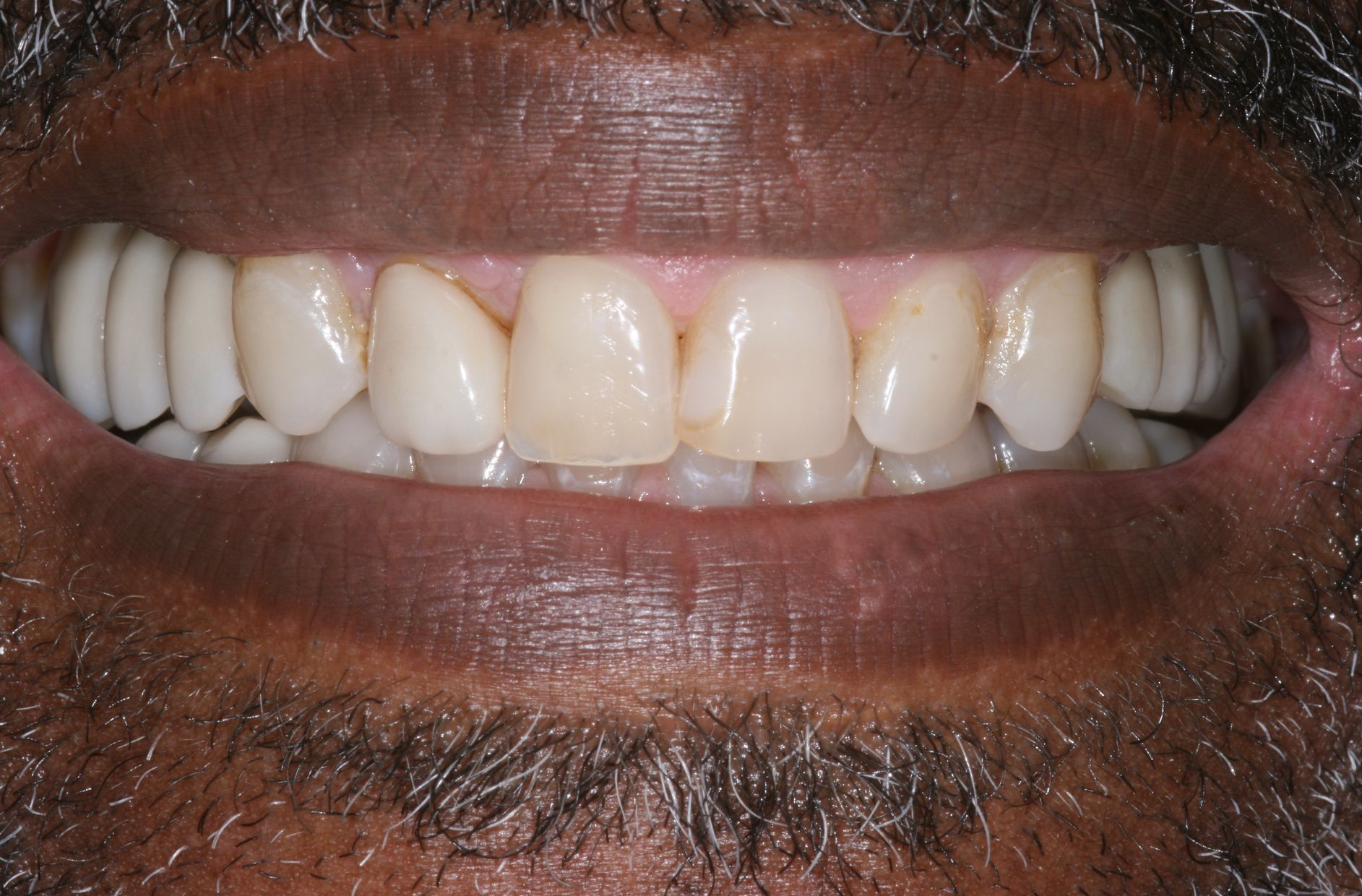 Close-up of a smiling mouth showing white teeth against dark lips and facial hair