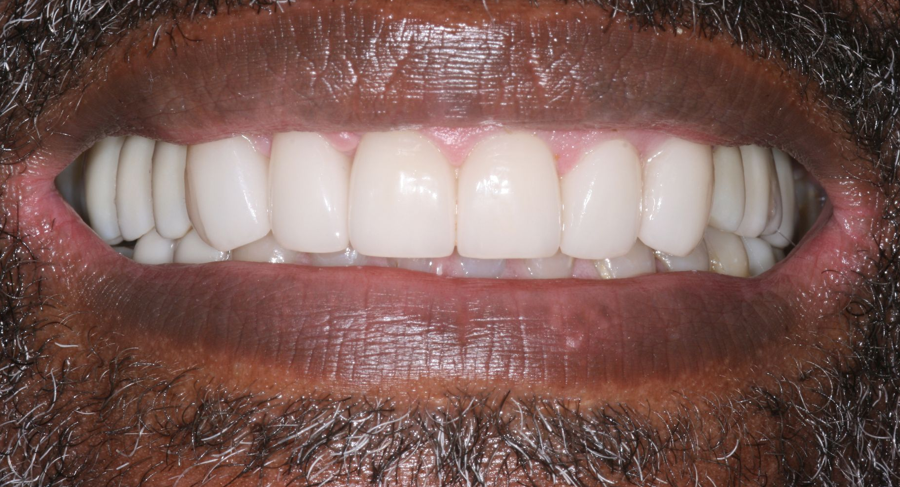 Close-up of a smiling mouth showing white teeth and dark facial hair.