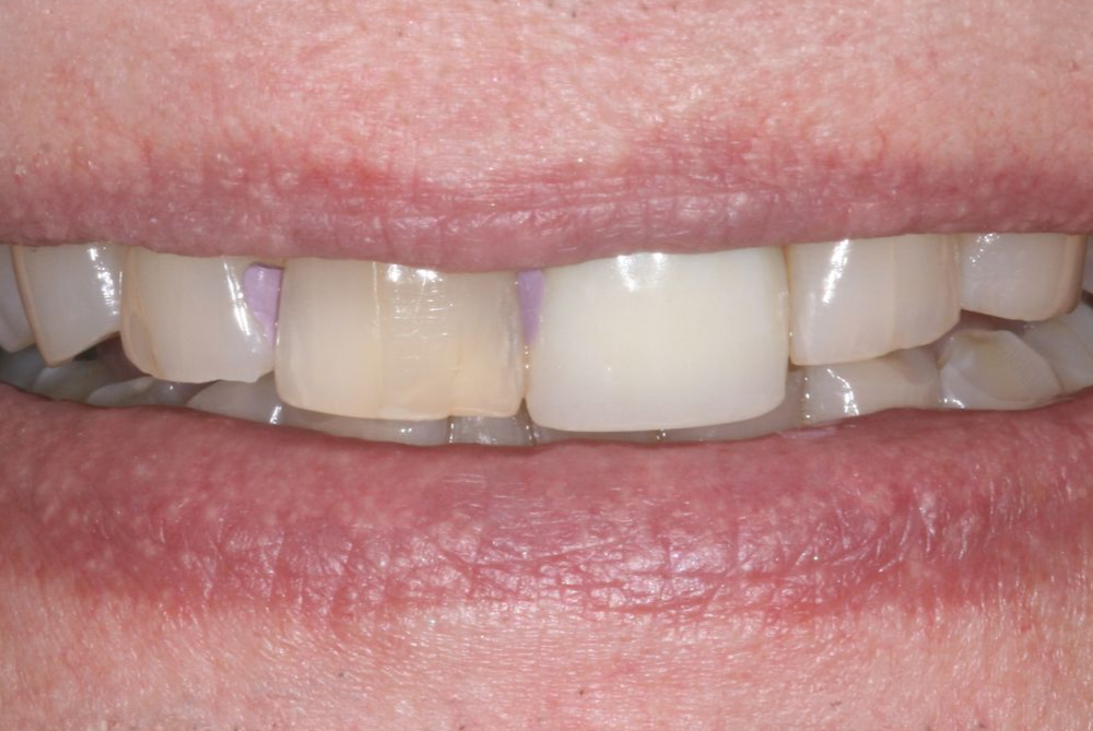 Close-up of lips showing front teeth, with a slightly uneven tooth alignment