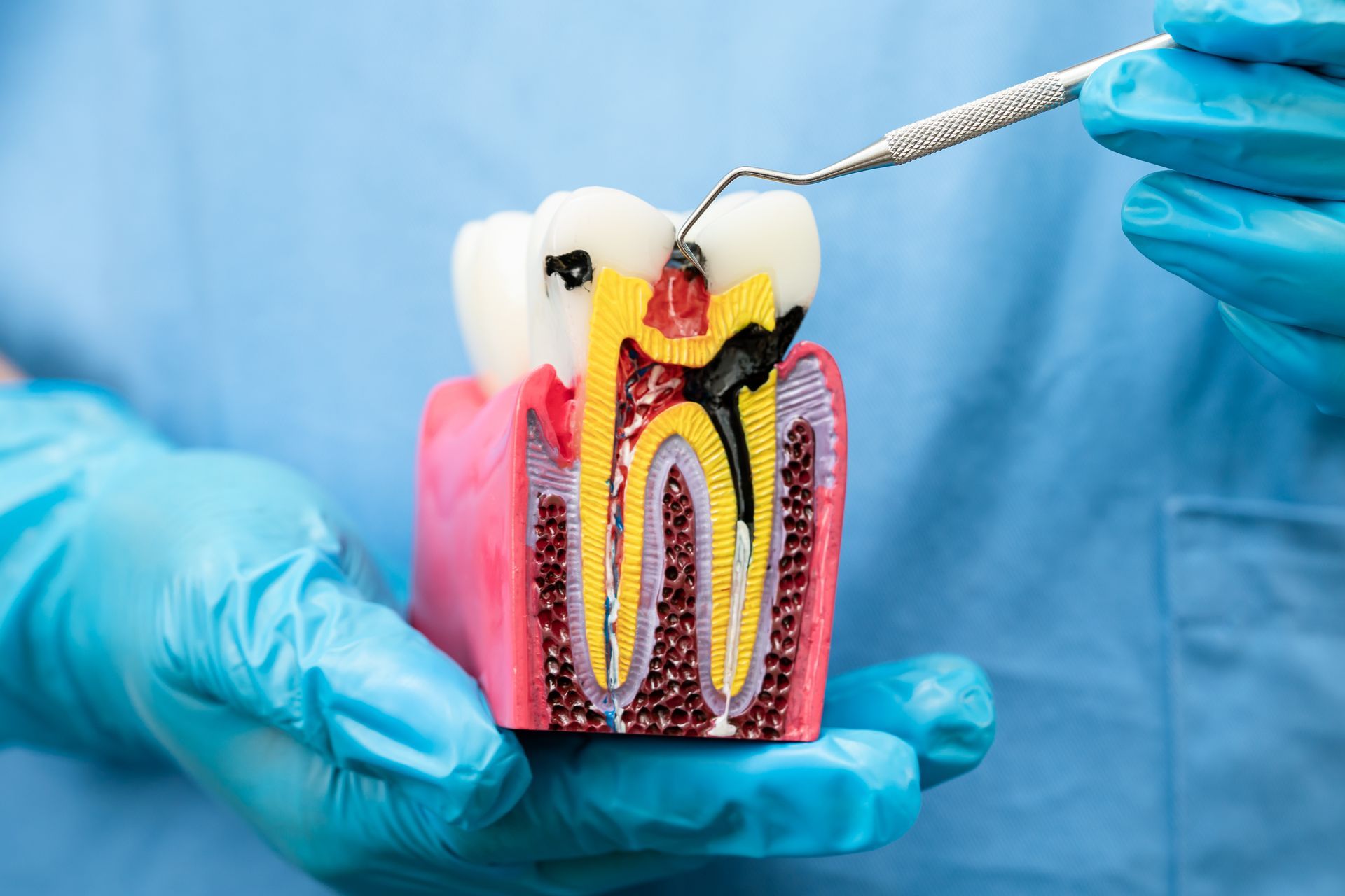 Dental model showing a cross-section of a tooth being cleaned by gloved hands with a dental tool