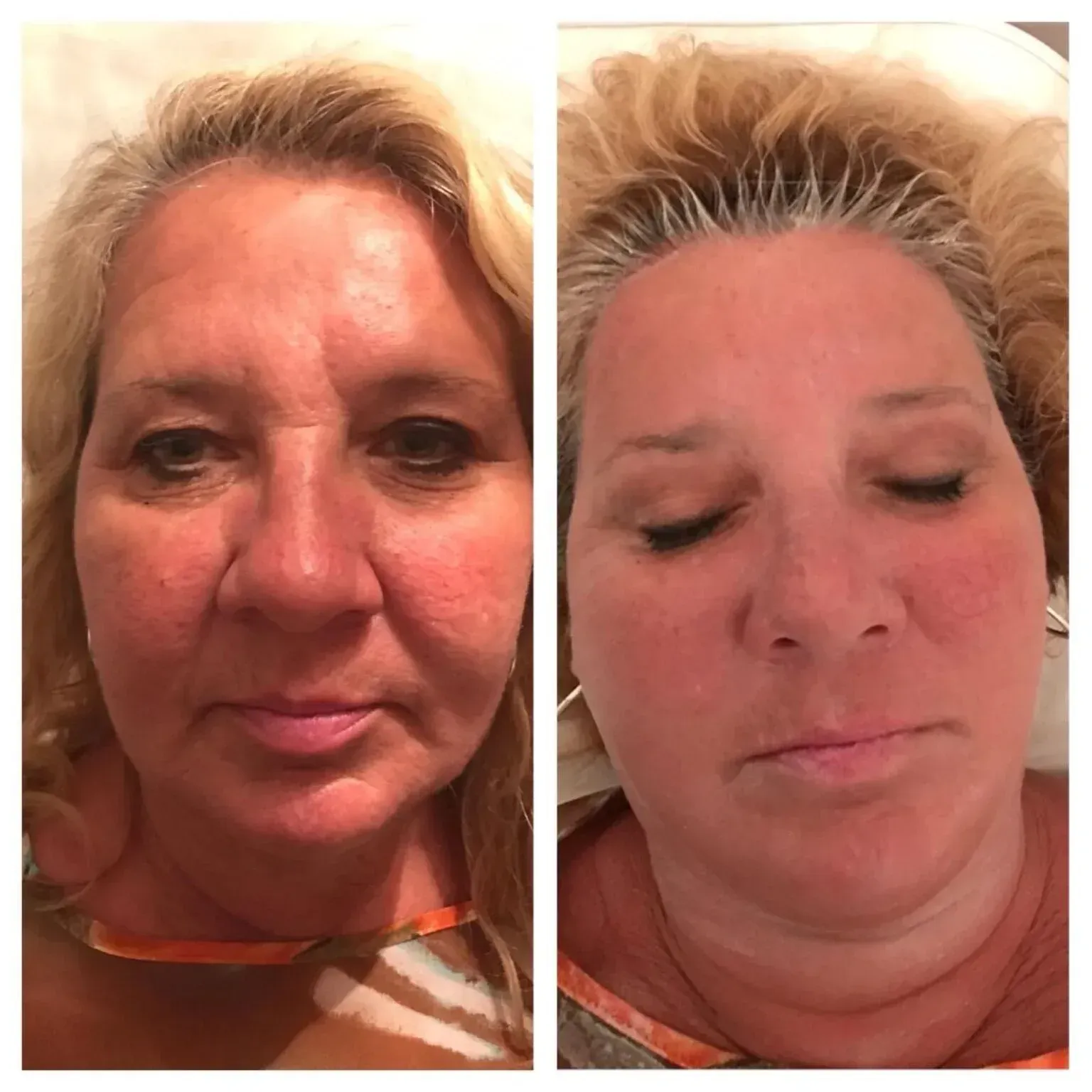 Side-by-side before and after photos of a woman's face. She has blonde hair, and appears relaxed in the after photo.