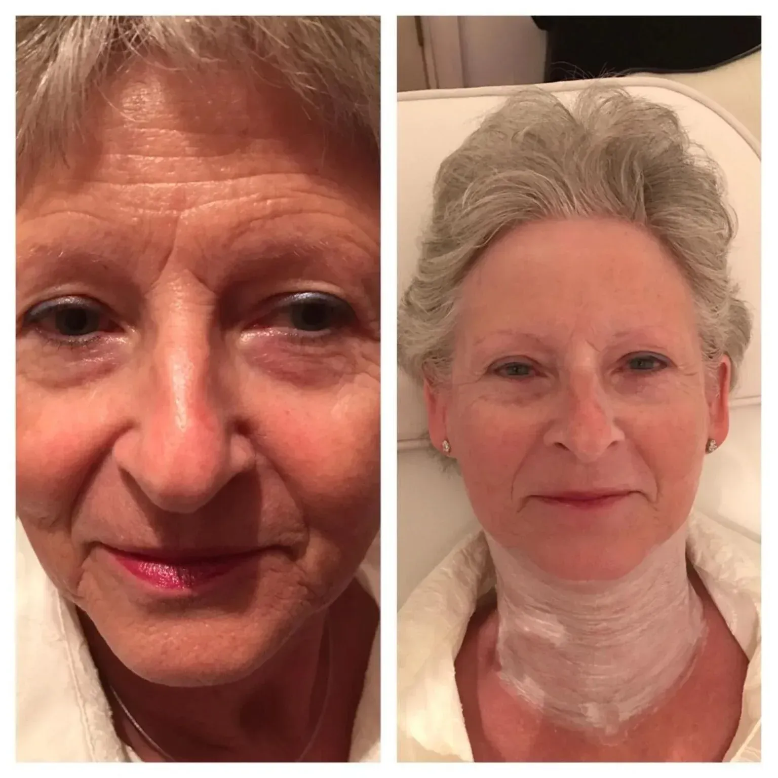 Woman's face before and after treatment; reduced wrinkles, smoother skin. Light skin tone, smiling.