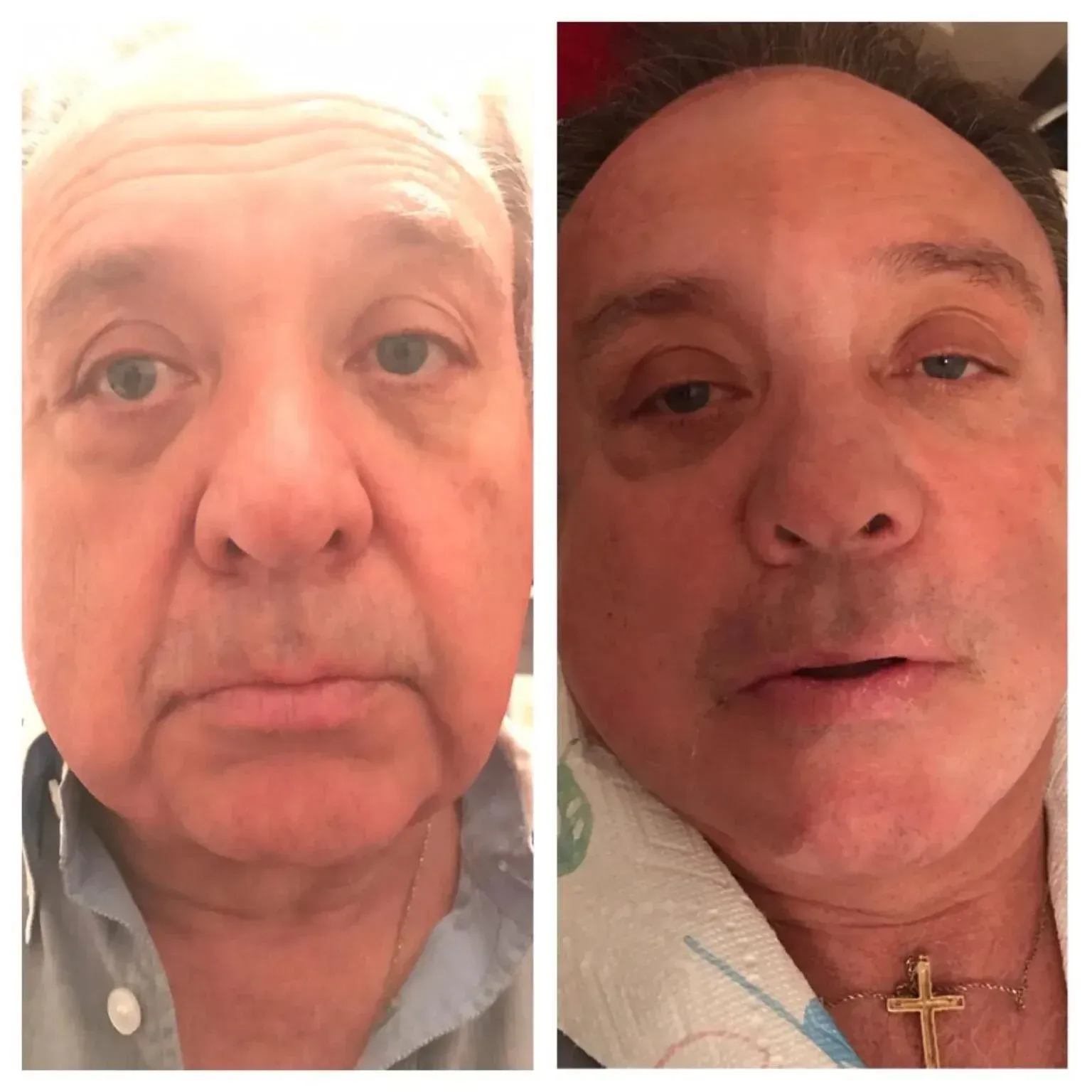 Side-by-side faces of a man. Left side has drooping skin. Right side has swollen face, wearing a cross.