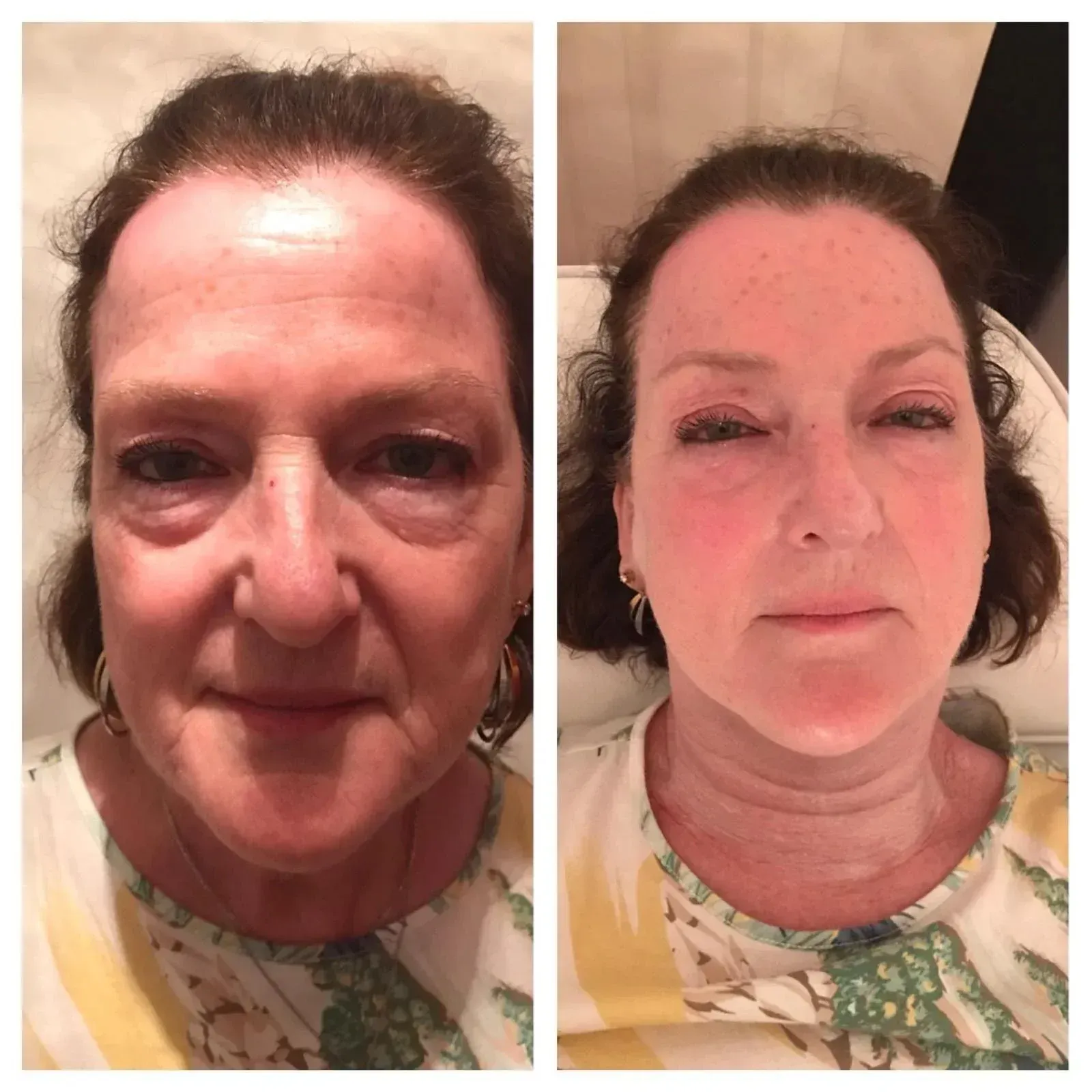 Before and after portraits of a woman's face, showing reduced wrinkles and rejuvenated skin, light skin tone.