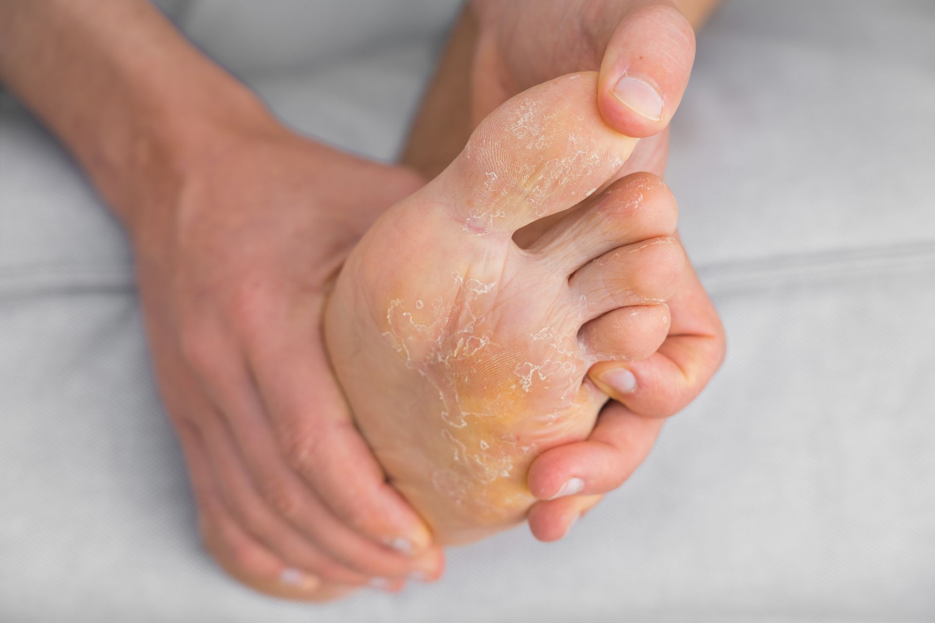 Person holding their foot with cracked skin on the sole and toes.