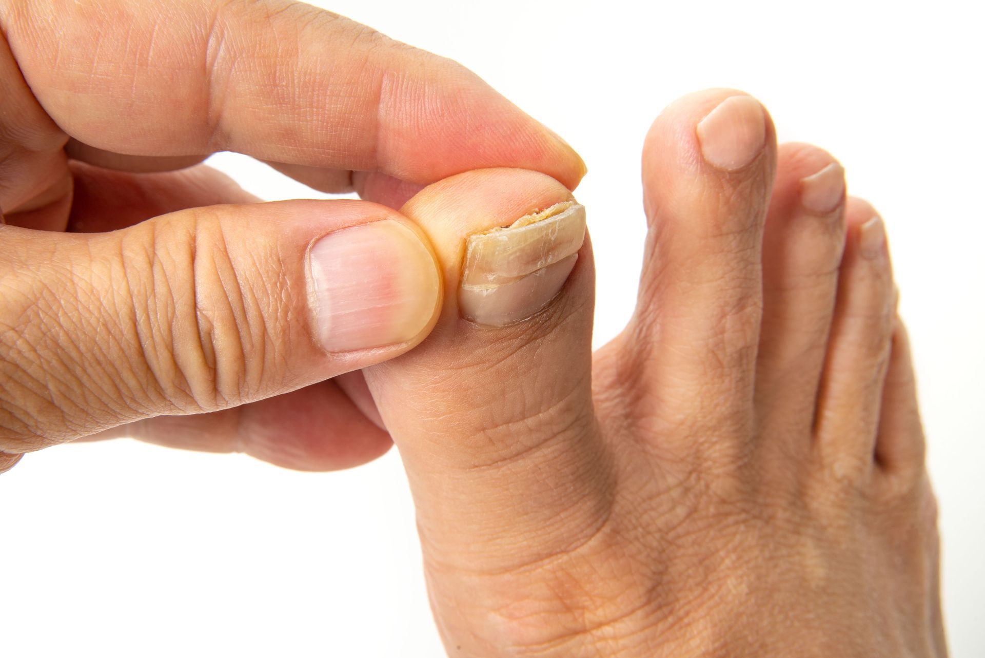 Close-up of a foot with a toe being held by a hand, showing a discolored and damaged toenail.