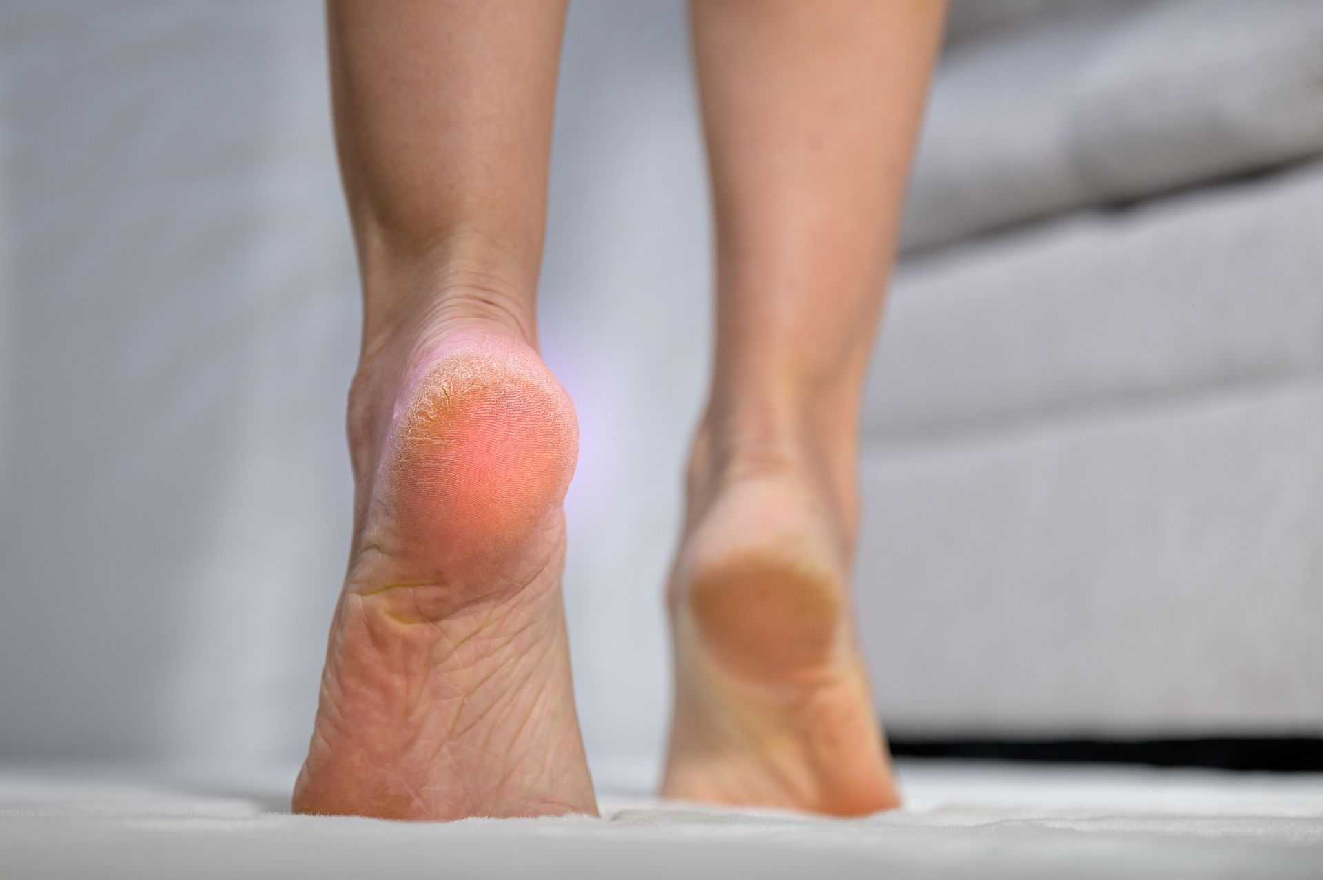 Close-up of bare feet with cracked heels, standing on a white surface.