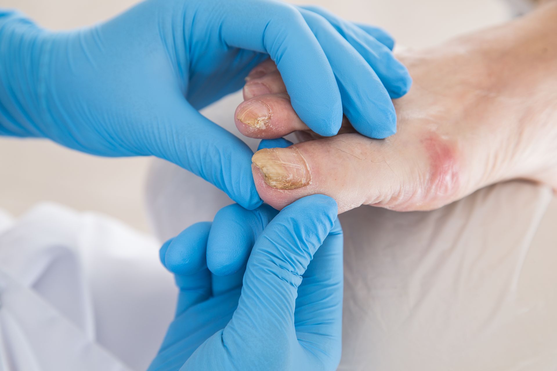 Doctor examines a foot with a fungal infection. Blue gloves, close-up shot.