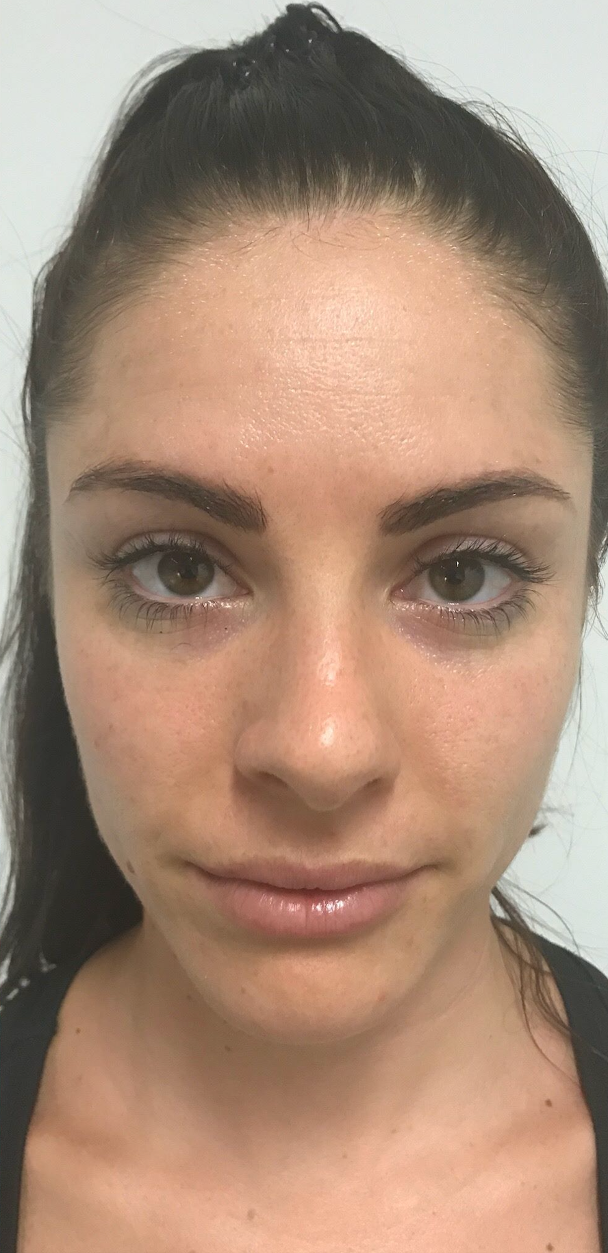 Woman with dark hair looking at the camera — Embrace Cosmetic Clinic in Bundaberg North, QLD