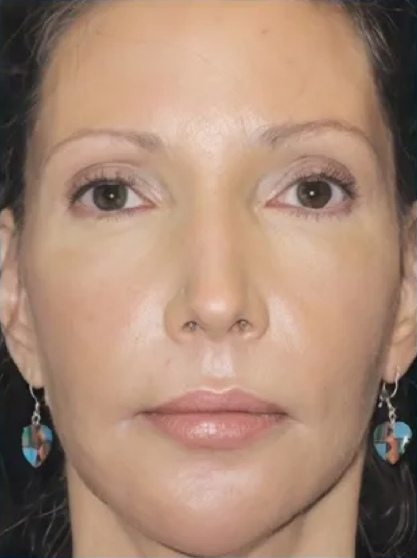 Before and After Photos Showing Facial Rejuvenation — Embrace Cosmetic Clinic in Bundaberg North, QLD