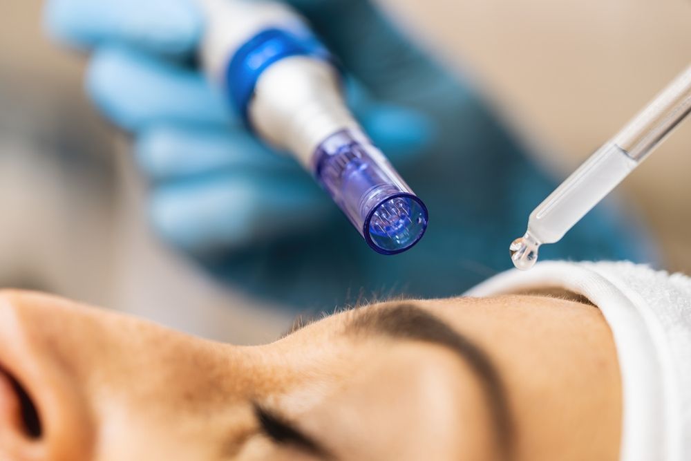 Microneedling Treatment: Device Over Face, Serum Applied — Embrace Cosmetic Clinic in Bundaberg North, QLD