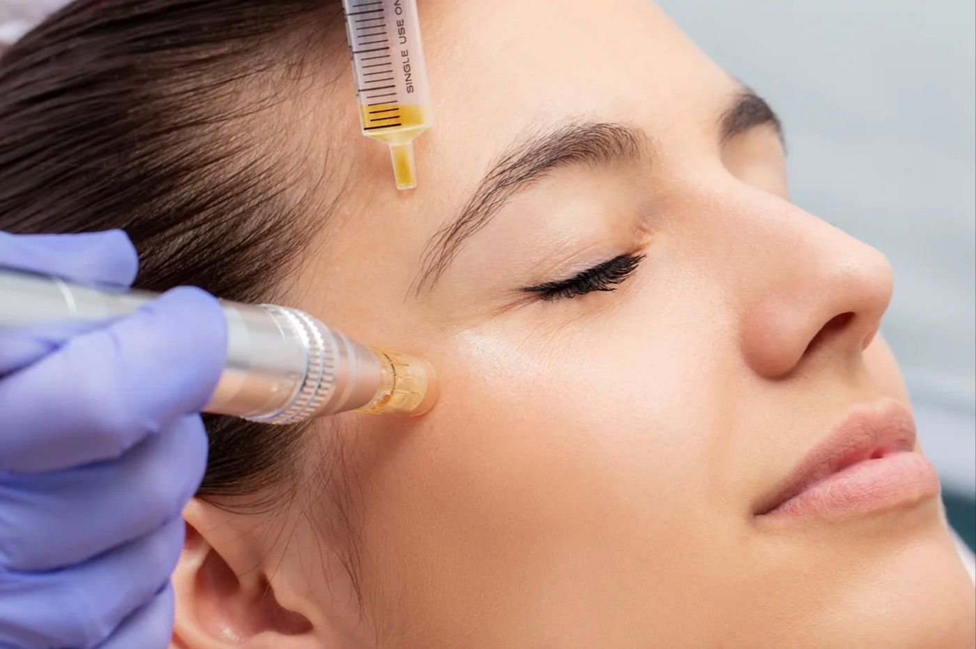 Person in Microneedling Treatment — Embrace Cosmetic Clinic in Bundaberg North, QLD