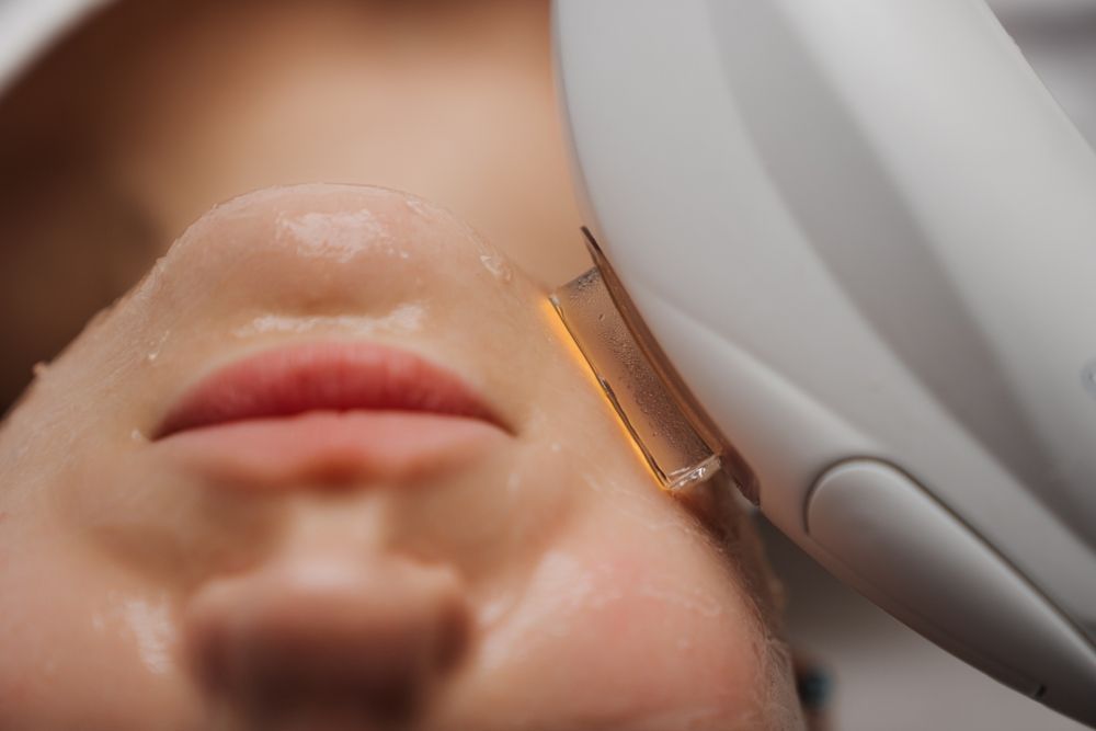 Close-up of a Person's Nose With Visible Pores and Slight Redness — Embrace Cosmetic Clinic in Bundaberg North, QLD