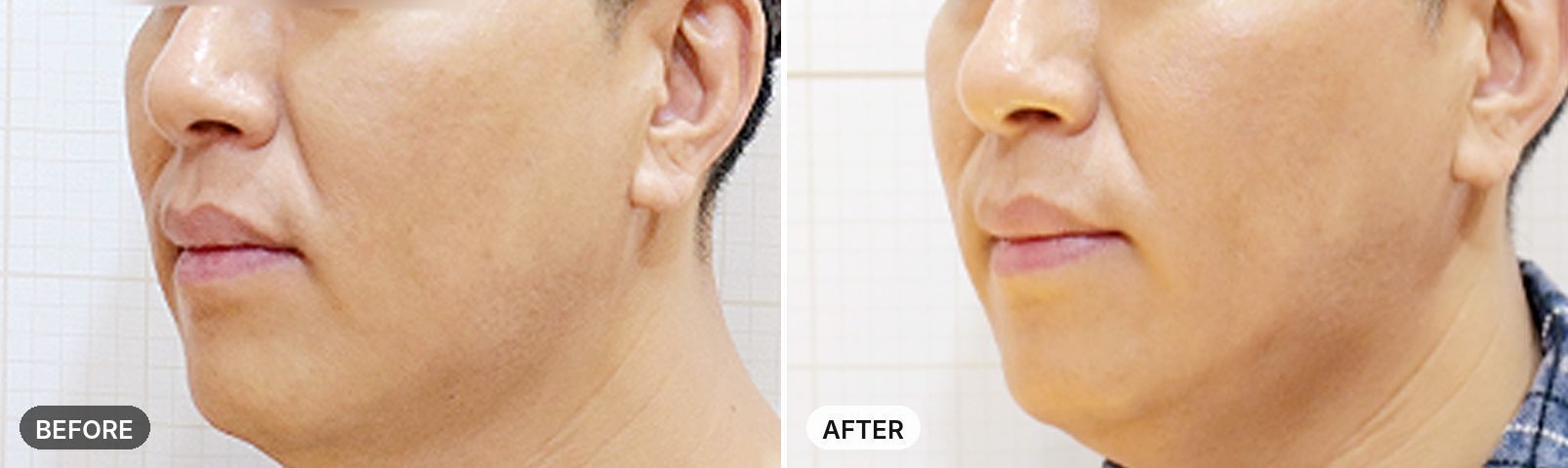 Thermage FLX before and after, case 1, JRYN Seomyeon Busan