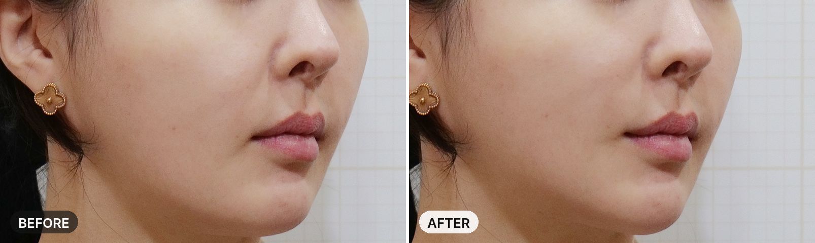 Tune Face before and after, case 1, JRYN Seomyeon Busan