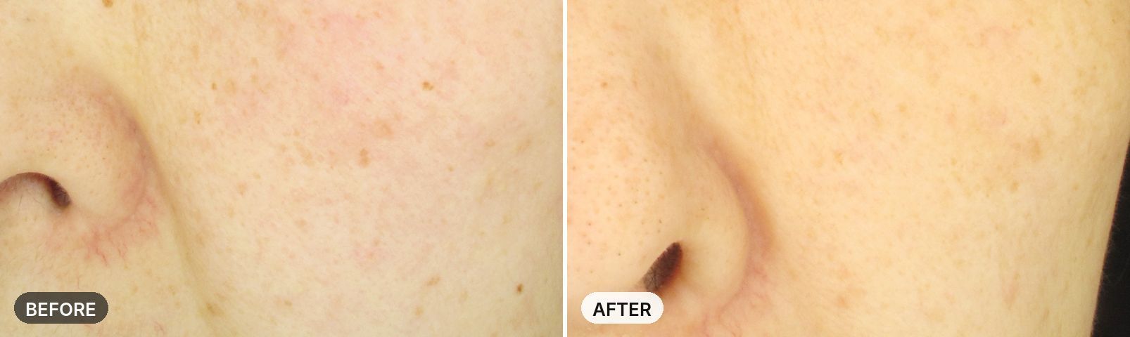 Skin Laser before and after, case 1, JRYN Seomyeon Busan