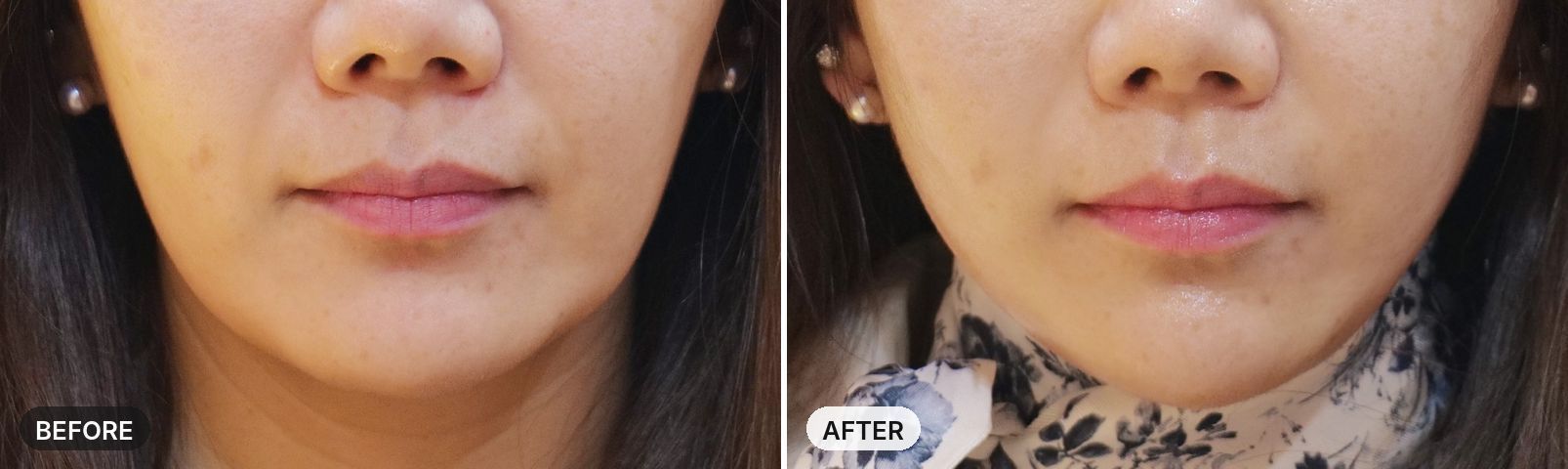 Onda Lifting before and after, case 9, JRYN Seomyeon Busan