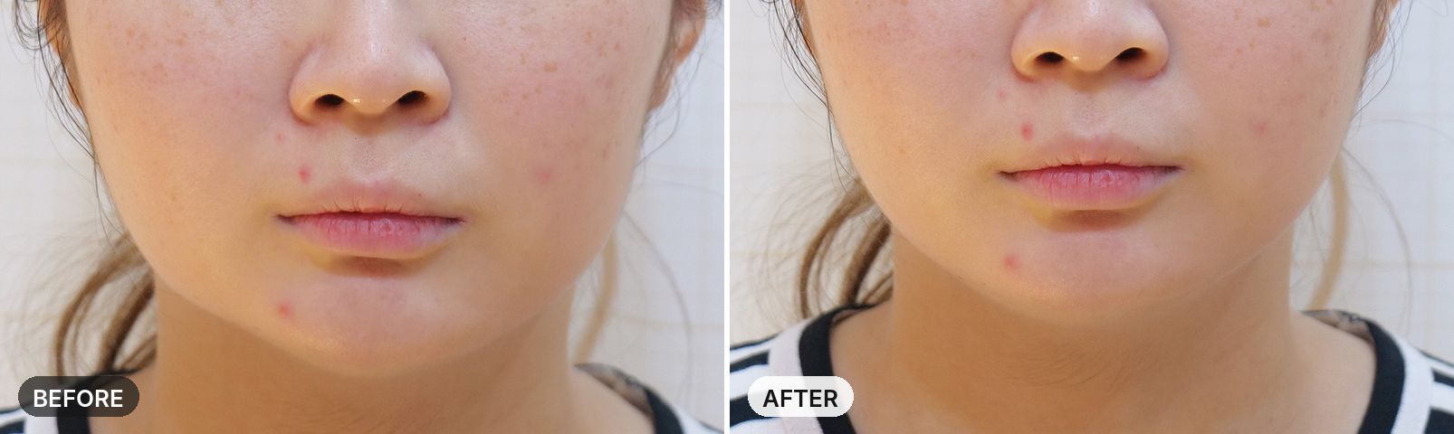 Titanium Lifting before and after, case 17, JRYN Seomyeon Busan