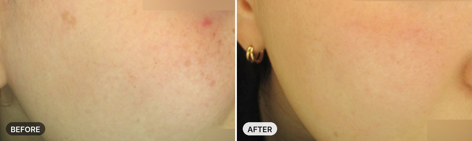 Premium All-in-One Course before and after, case 5, JRYN Seomyeon Busan