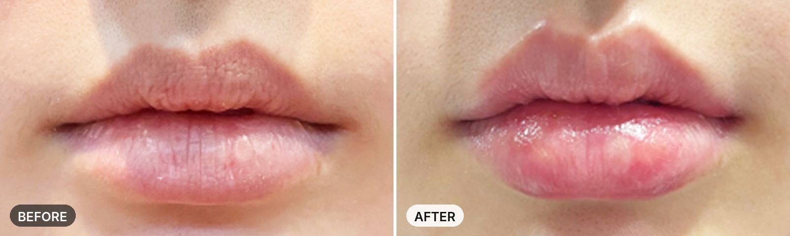Lip Filler before and after, case 2, JRYN Seomyeon Busan