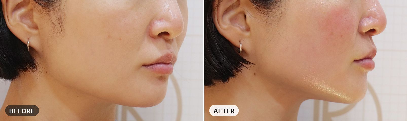 Titanium Lifting before and after, case 18, JRYN Seomyeon Busan