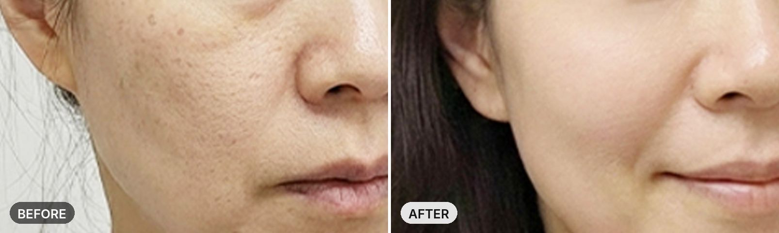 Re2O before and after, case 1, JRYN Seomyeon Busan