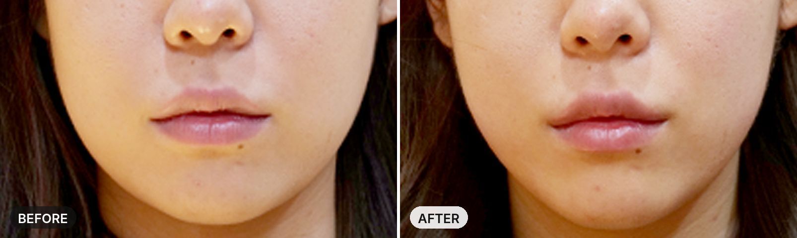 Titanium Lifting before and after, case 11, JRYN Seomyeon Busan