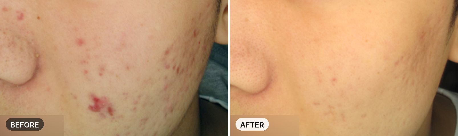 Premium All-in-One Course before and after, case 4, JRYN Seomyeon Busan